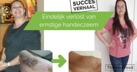 Onbehandelbare eczeem verdwijnt