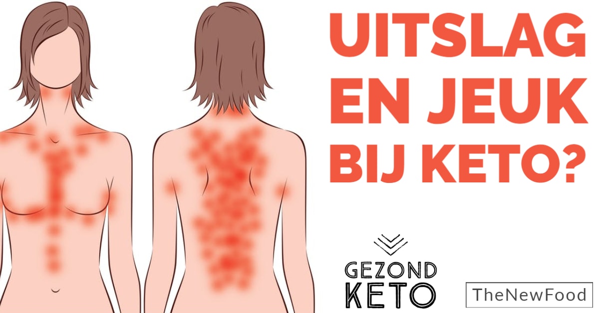 Starten met keto en jeuk/uitslag (keto rash)