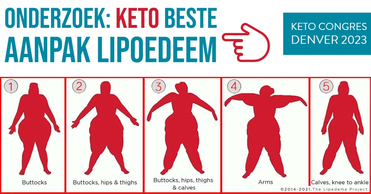 Keto zeer effectief bij lipoedeem